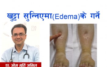 खुट्टा सुन्निएमा (Edema) के गर्ने ?